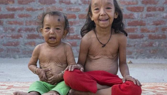 Hindistan’da dünyaya gelen kardeşler, sıra dışı hastalıkları yüzünden doğumlarından beri yaşlı görünüyor